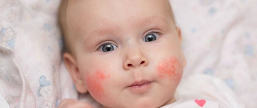 Hogyan kezeljük az atópiás dermatitist? – Amikor a bőr gyógyulása belülről indul