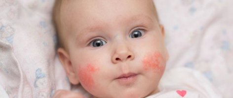 Hogyan kezeljük az atópiás dermatitist? – Amikor a bőr gyógyulása belülről indul